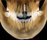 I-CAT 3D imaging photo front of teeth 