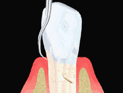 Root planing animation